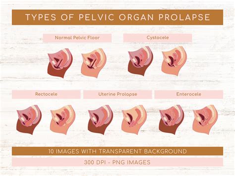 Pelvic organ prolapse .